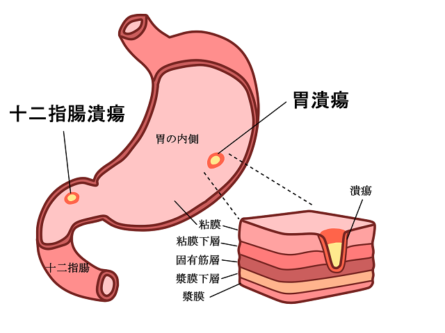 胃潰瘍イメージ