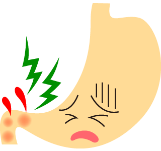 十二指腸潰瘍のイメージ