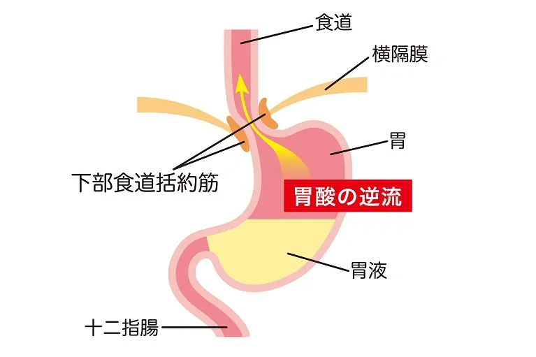 逆流性食道炎引用画像02