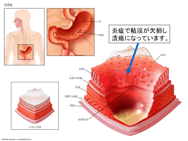 胃潰瘍の症状引用画像