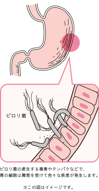 ピロリ菌の疾患引用画像